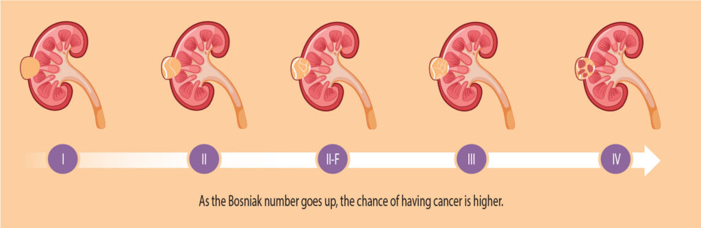 A graphic detailing the Bosniak classification system for renal cysts (fluid-filled sacs in the kidney) from Category 1 to Category 4.