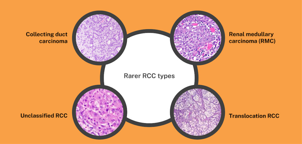 A graphic displaying microscopic pictures of the 4 rare renal cell carcinomas.