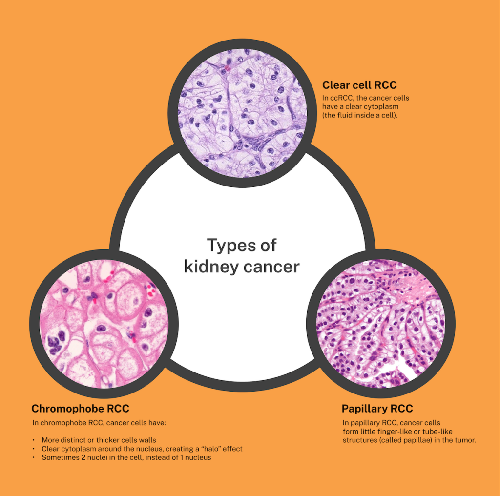 A graphic displaying the three 3 most common types of renal cell carcinoma look under a microscope.